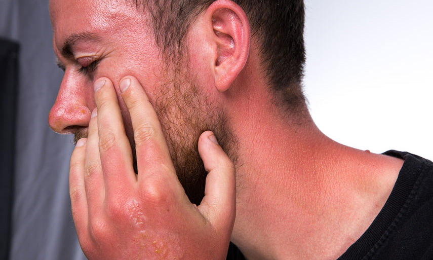 sun burn with swelling and blisters
