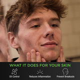 Acne Serum 30 day supply